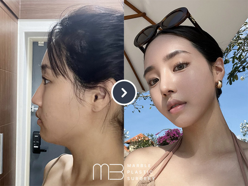 코,턱밑 지흡,실리프팅