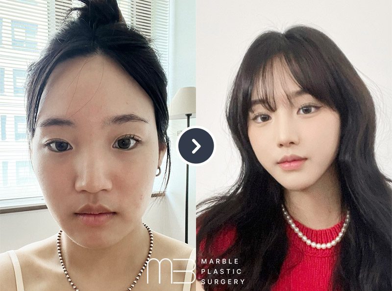 코,턱밑 지흡,실리프팅