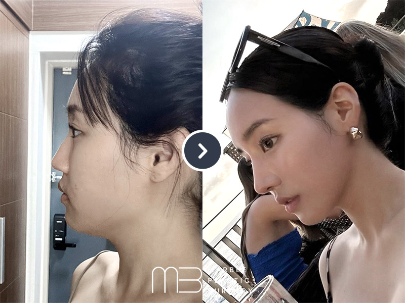 코,턱밑 지흡,실리프팅