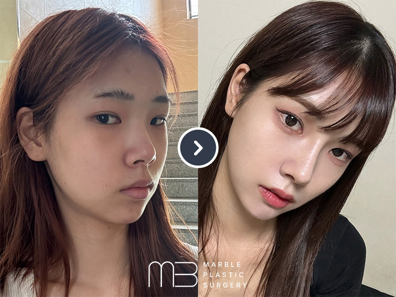 앞트임,윗트임,뒷트임,눈밑지,코,턱 보형물