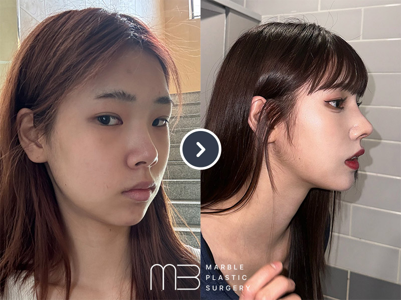 앞트임,윗트임,뒷트임,눈밑지,코,턱 보형물