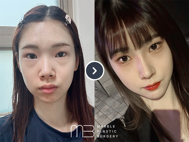 앞트임,윗트임,뒷트임,눈밑지,코,턱 보형물