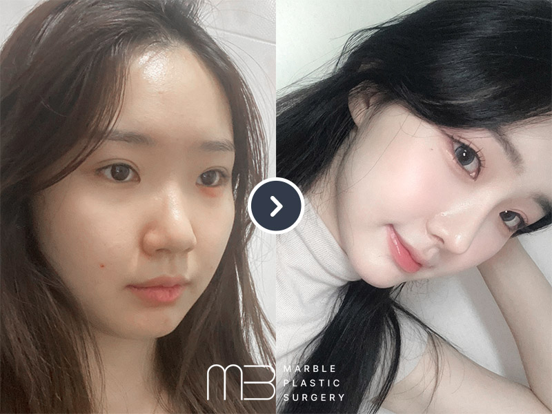 코,턱보형물