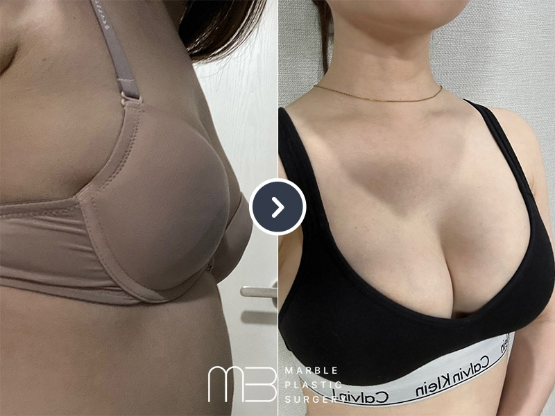 가슴확대술