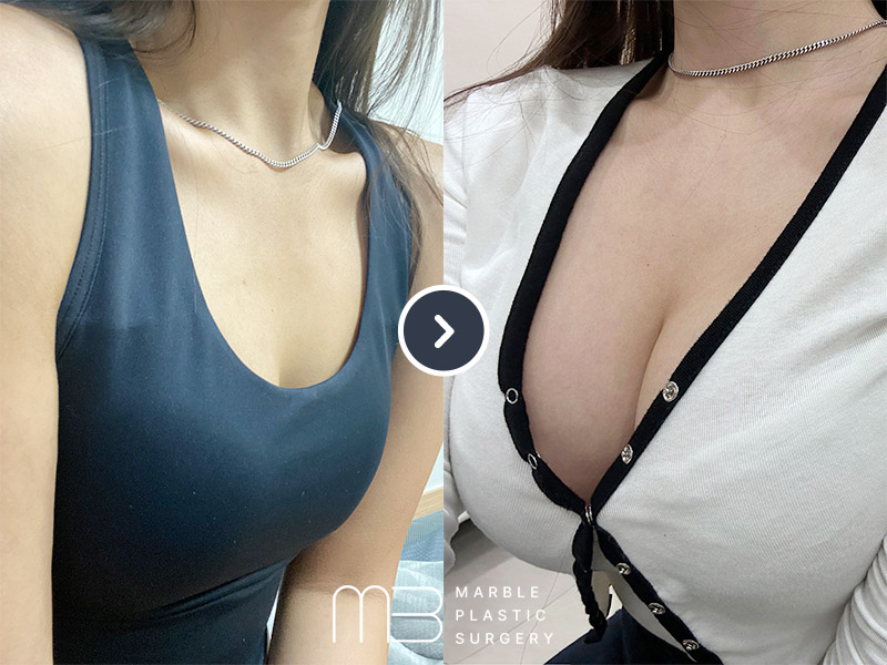 가슴확대술