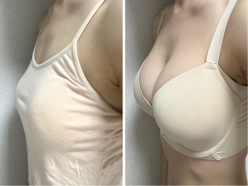豊胸手術